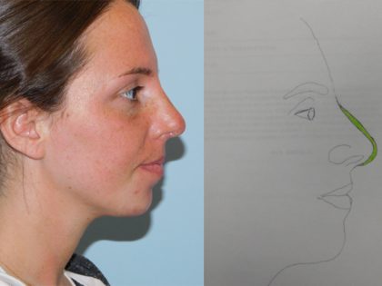 Rhinoplasty Before & After Patient #2704