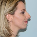 Rhinoplasty Before & After Patient #2704