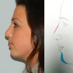 Rhinoplasty Before & After Patient #2703