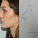 Rhinoplasty Before & After Patient #2702