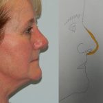 Rhinoplasty Before & After Patient #2701