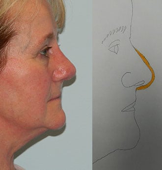 Rhinoplasty Before & After Patient #2701