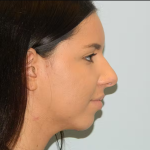 Rhinoplasty Before & After Patient #2700