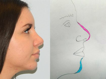Rhinoplasty Before & After Patient #2700