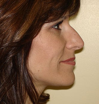 Rhinoplasty Before & After Patient #2699