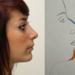 Rhinoplasty Before & After Patient #2698