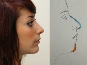 Rhinoplasty Before & After Patient #2698