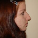 Rhinoplasty Before & After Patient #2706