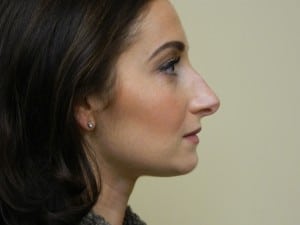 Rhinoplasty Before & After Patient #2697