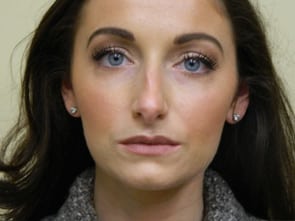 Rhinoplasty Before & After Patient #2697