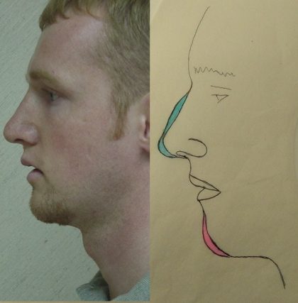Rhinoplasty Before & After Patient #2696
