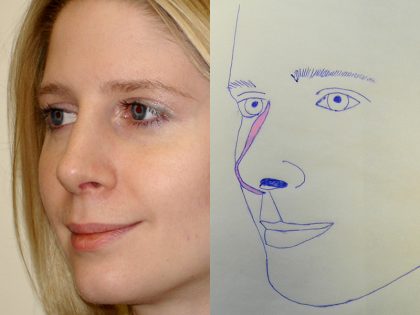 Rhinoplasty Before & After Patient #2695
