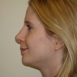 Rhinoplasty Before & After Patient #2695