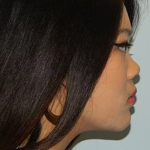 Rhinoplasty Before & After Patient #2694