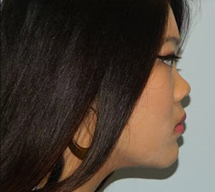 Rhinoplasty Before & After Patient #2694