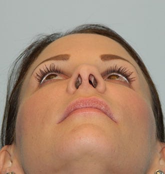 Rhinoplasty Before & After Patient #2693