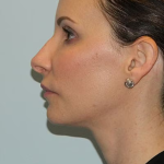 Rhinoplasty Before & After Patient #2693