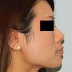 Rhinoplasty Before & After Patient #2692