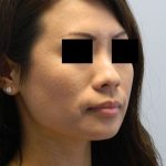 Rhinoplasty Before & After Patient #2692