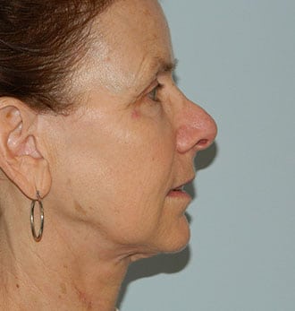 Rhinoplasty Before & After Patient #2691