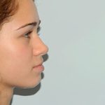 Rhinoplasty Before & After Patient #2690