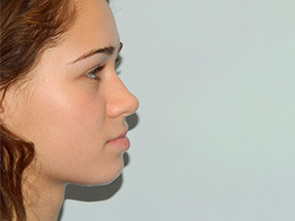Rhinoplasty Before & After Patient #2690