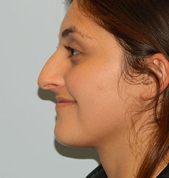Rhinoplasty Before & After Patient #2689