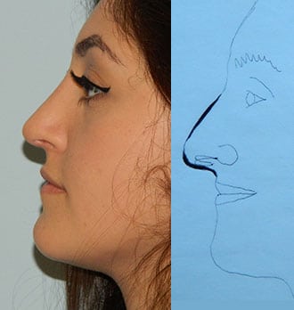 Rhinoplasty Before & After Patient #2689