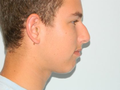 Rhinoplasty Before & After Patient #2688