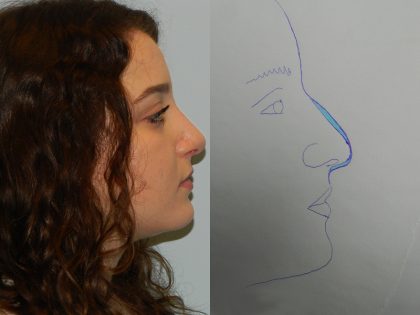 Rhinoplasty Before & After Patient #2687