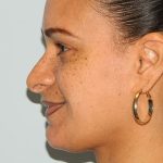 Rhinoplasty Before & After Patient #2685