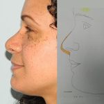 Rhinoplasty Before & After Patient #2685
