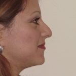 Rhinoplasty Before & After Patient #2684