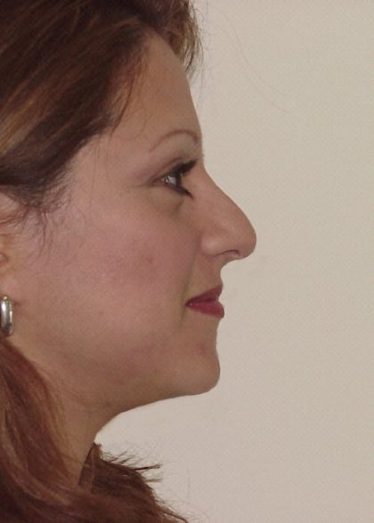 Rhinoplasty Before & After Patient #2684