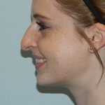 Rhinoplasty Before & After Patient #2683