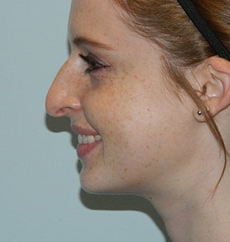 Rhinoplasty Before & After Patient #2683