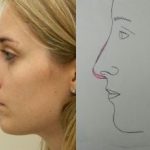 Rhinoplasty Before & After Patient #2681