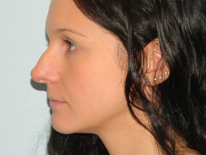 Rhinoplasty Before & After Patient #2679