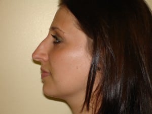 Rhinoplasty Before & After Patient #2678