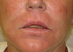 Fraxel Laser Resurfacing Before & After Patient #1174