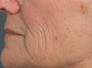 Fraxel Laser Resurfacing Before & After Patient #1171