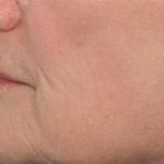 Fraxel Laser Resurfacing Before & After Patient #1171