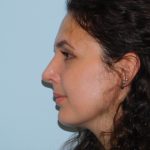 Rhinoplasty Before & After Patient #3050