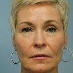Traditional Facelift Before & After Patient #3548