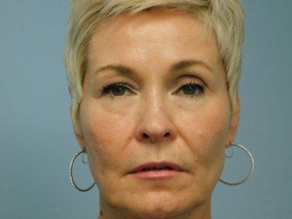 Blepharoplasty Before & After Patient #3541