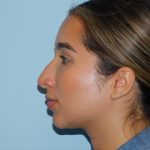 Rhinoplasty Before & After Patient #3413