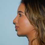 Rhinoplasty Before & After Patient #3413