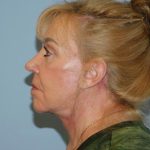 Traditional Facelift Before & After Patient #3623