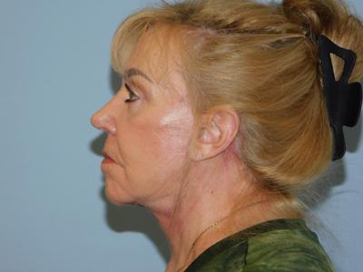Traditional Facelift Before & After Patient #3623
