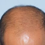 Hair Transplant Smartgraft Before & After Patient #3637